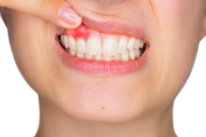 gums care tips